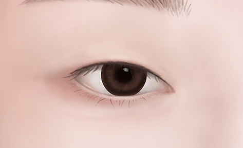 수술방법