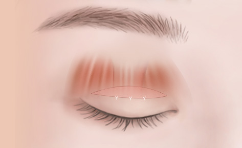 수술방법 
