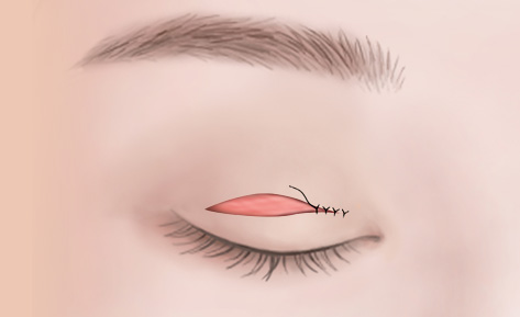 수술방법