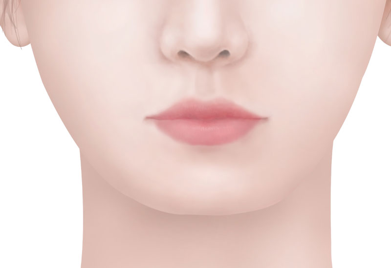수술방법