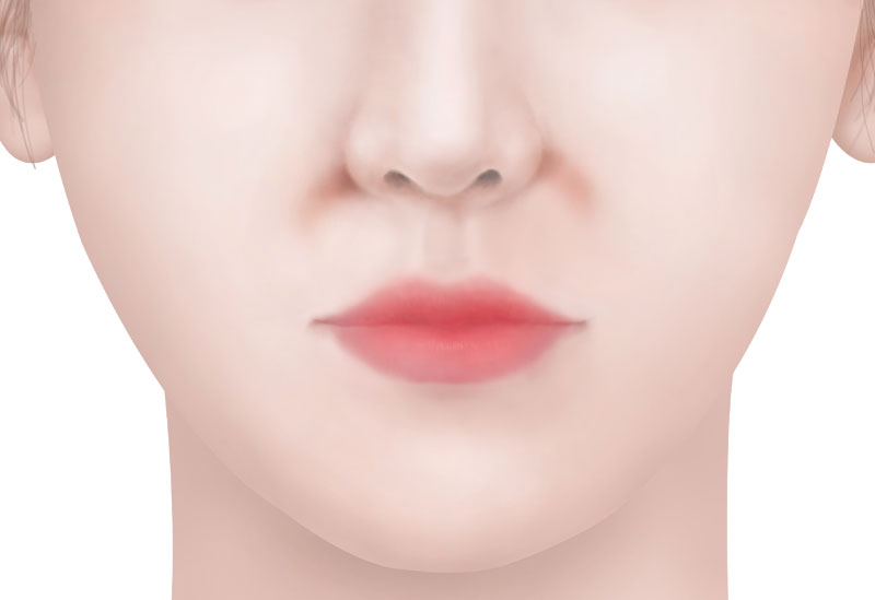 수술방법