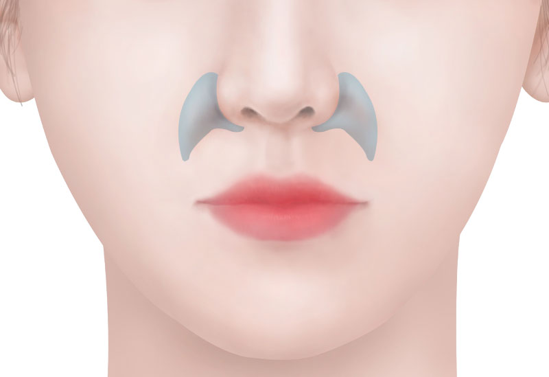 수술방법