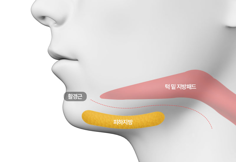 수술방법