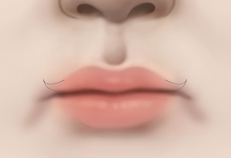 수술방법