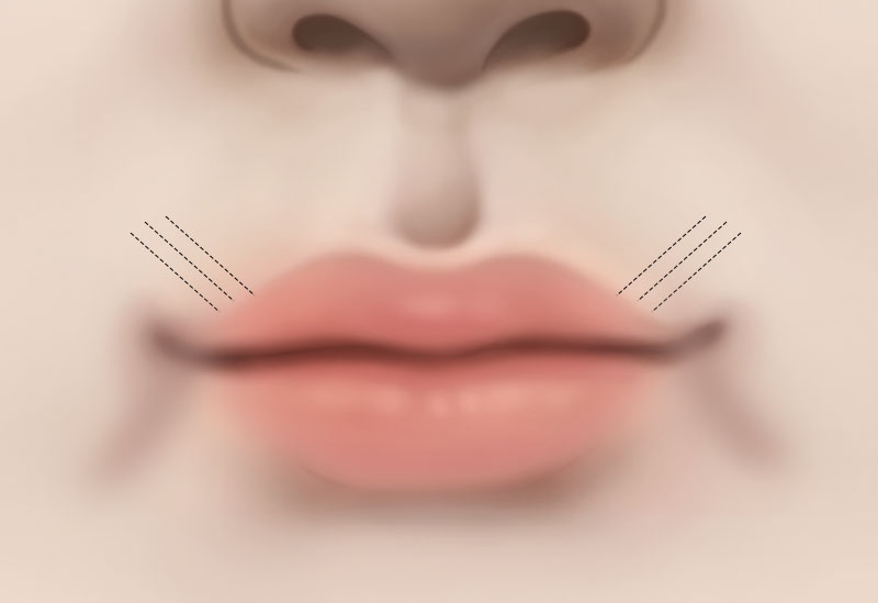수술방법 