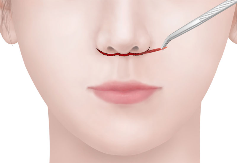 수술방법