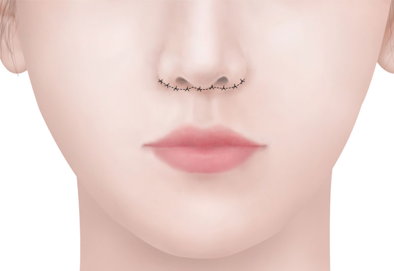 수술방법 