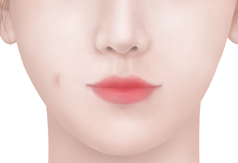 수술방법 