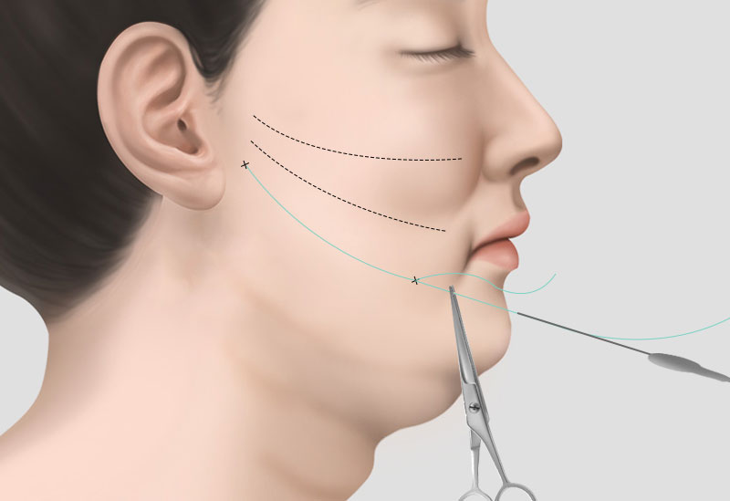 수술방법 