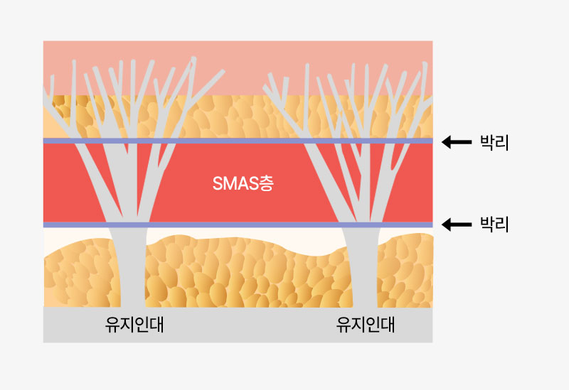 수술방법