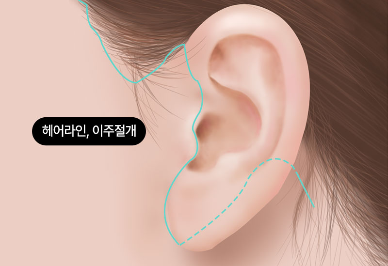 수술방법