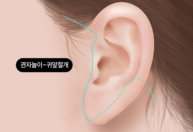 수술방법