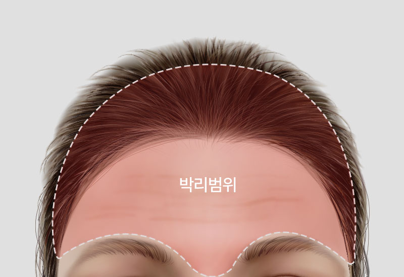 수술방법