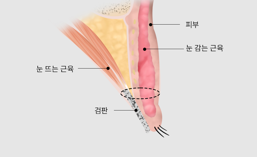 수술방법