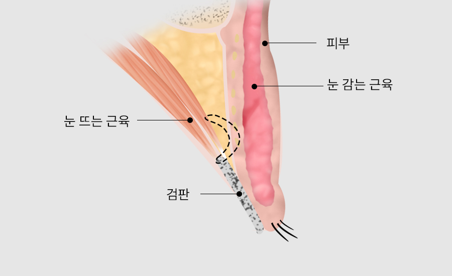 수술방법