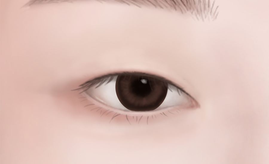 수술방법