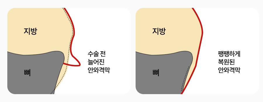 수술방법