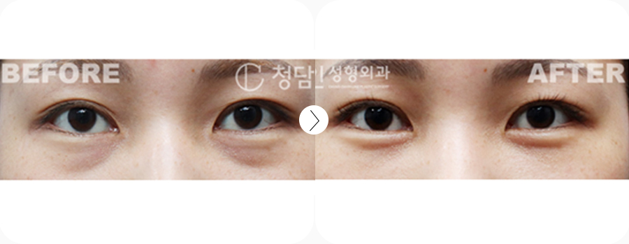 수술방법