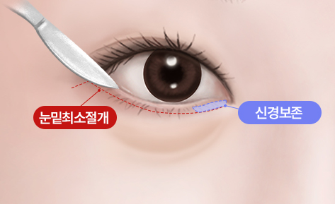 수술방법