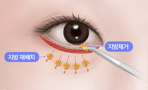 수술방법 