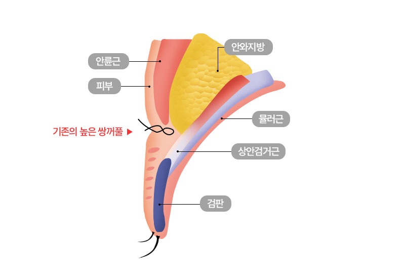 수술방법