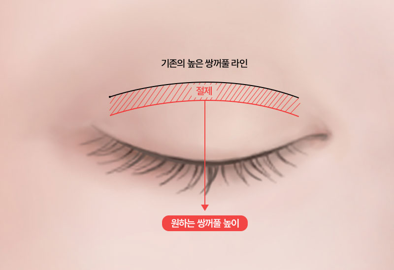 수술방법