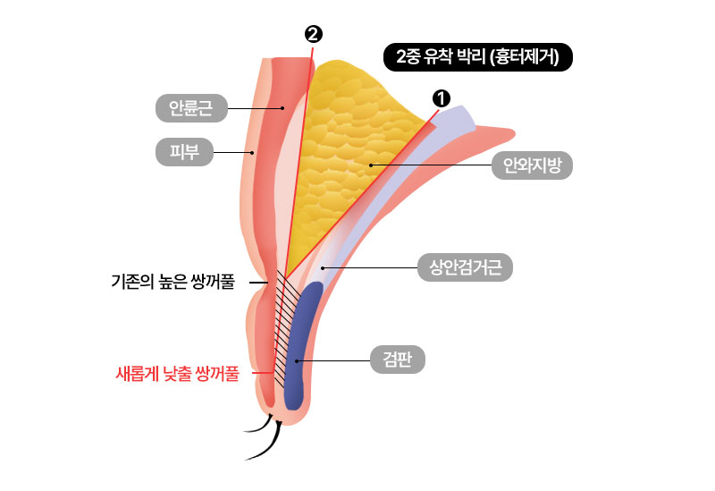 수술방법