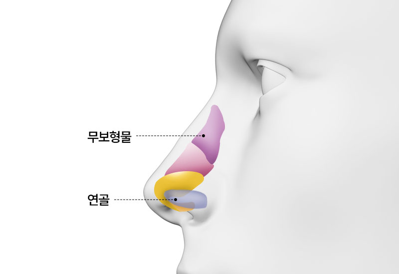 수술방법