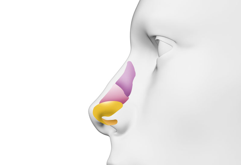 수술방법