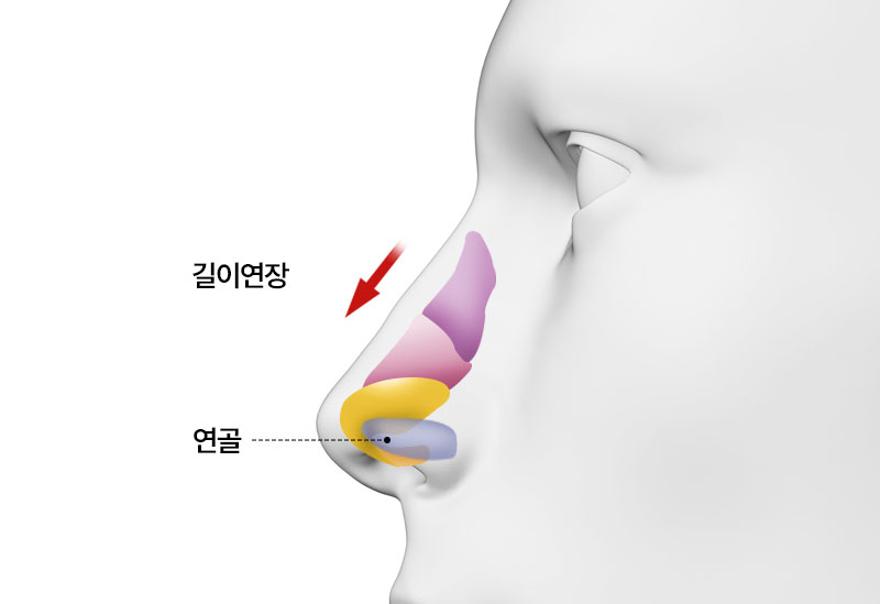 수술방법