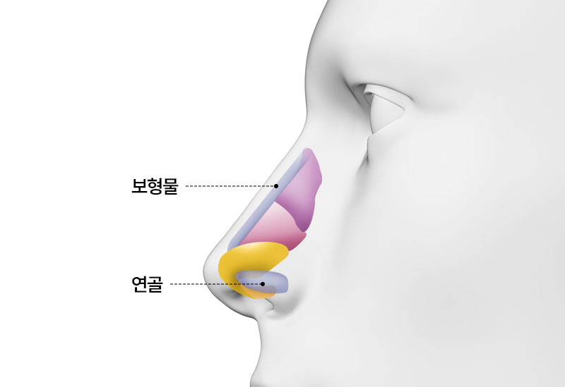 수술방법