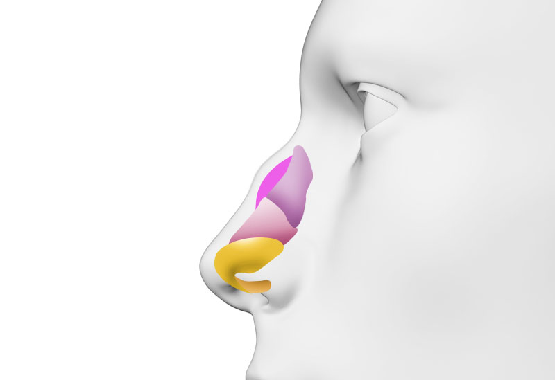 수술방법