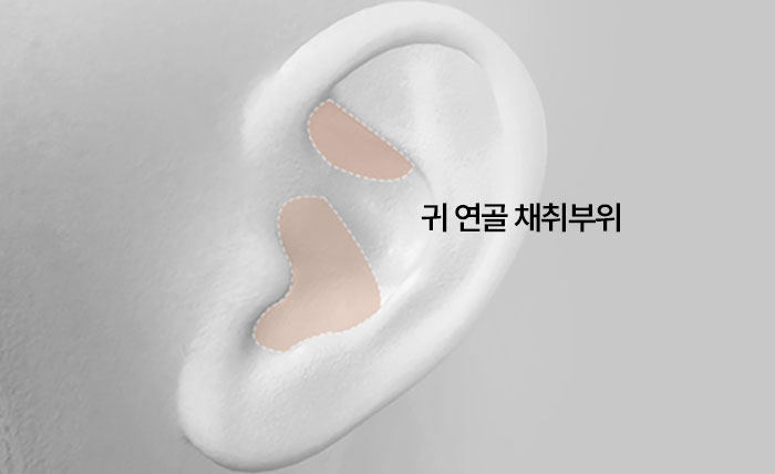 수술방법