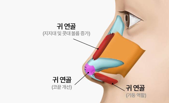 수술방법