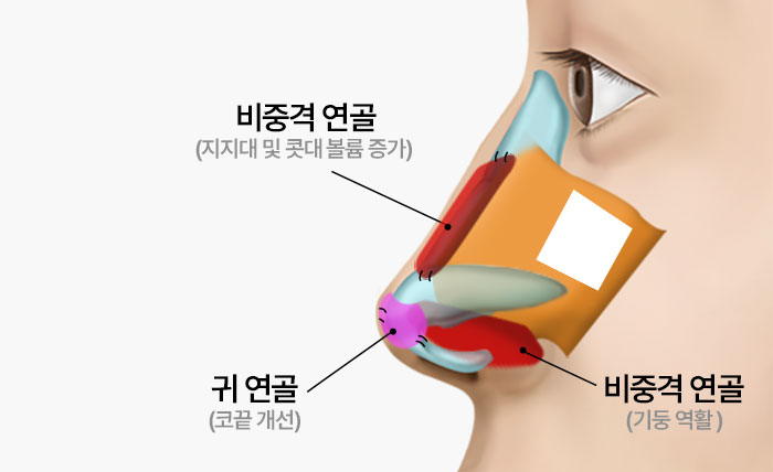 수술방법