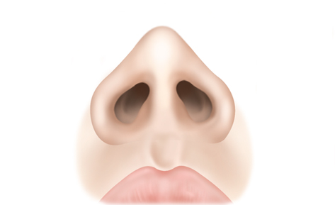 수술방법 