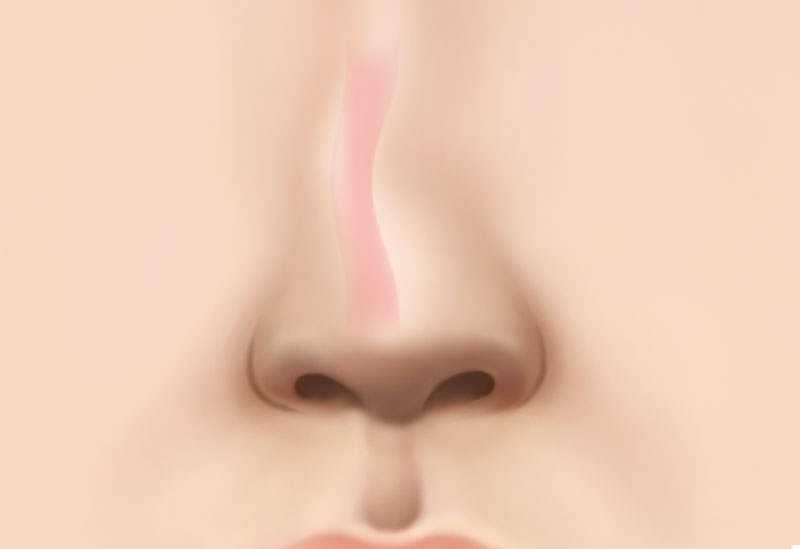 수술방법