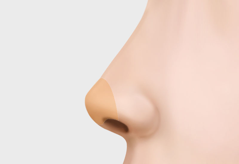 수술방법