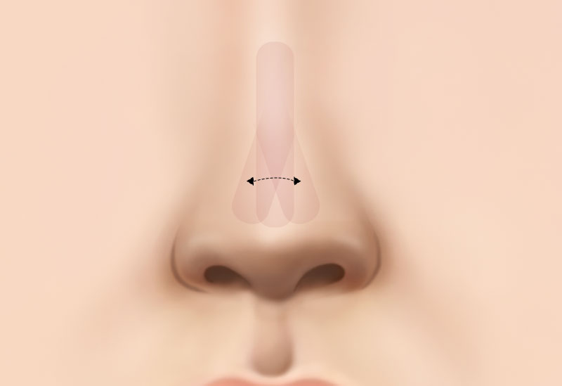 수술방법