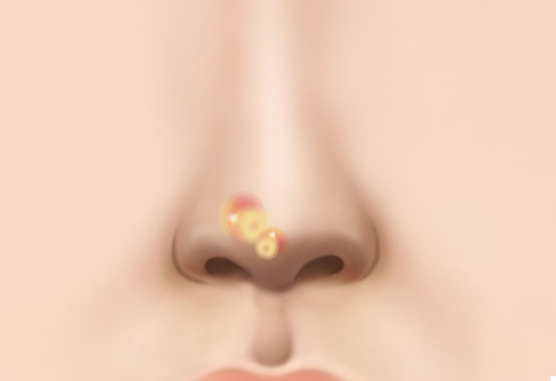 수술방법
