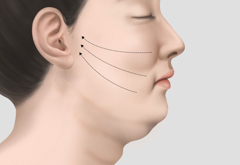 수원 실리프팅, 팔자주름·턱선에 효과가 있을까요? 유지기간과 회복, 부작용