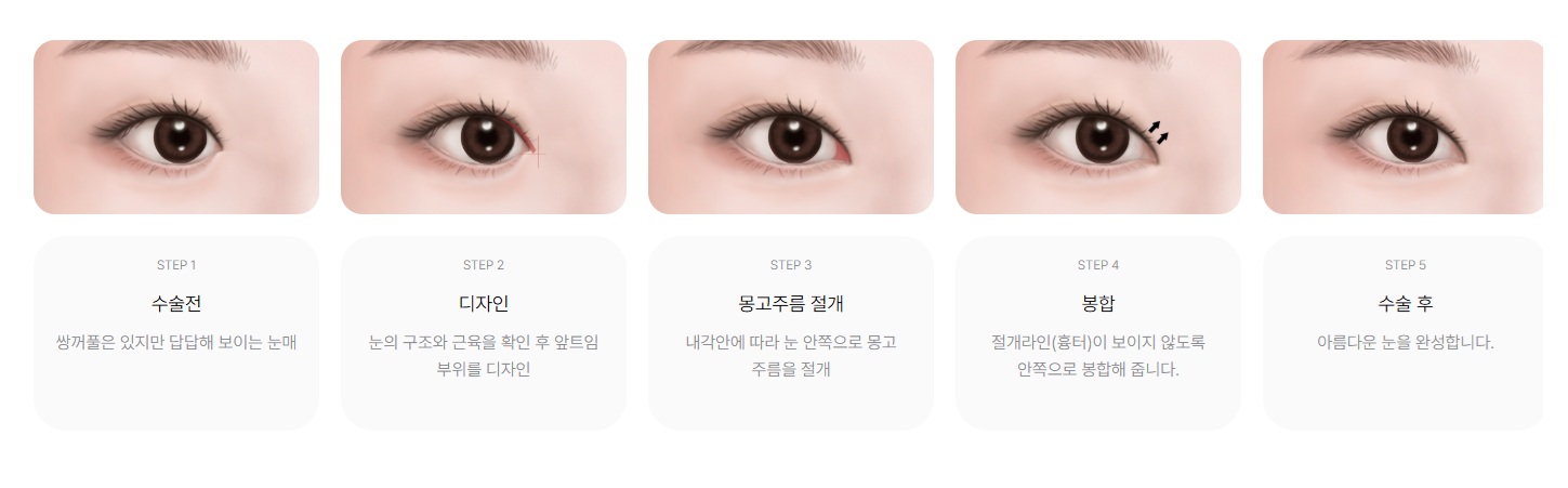 수원 앞트임, 꼭 필요한 눈은? 몽고주름·흉터·쌍꺼풀 병행과 회복기간